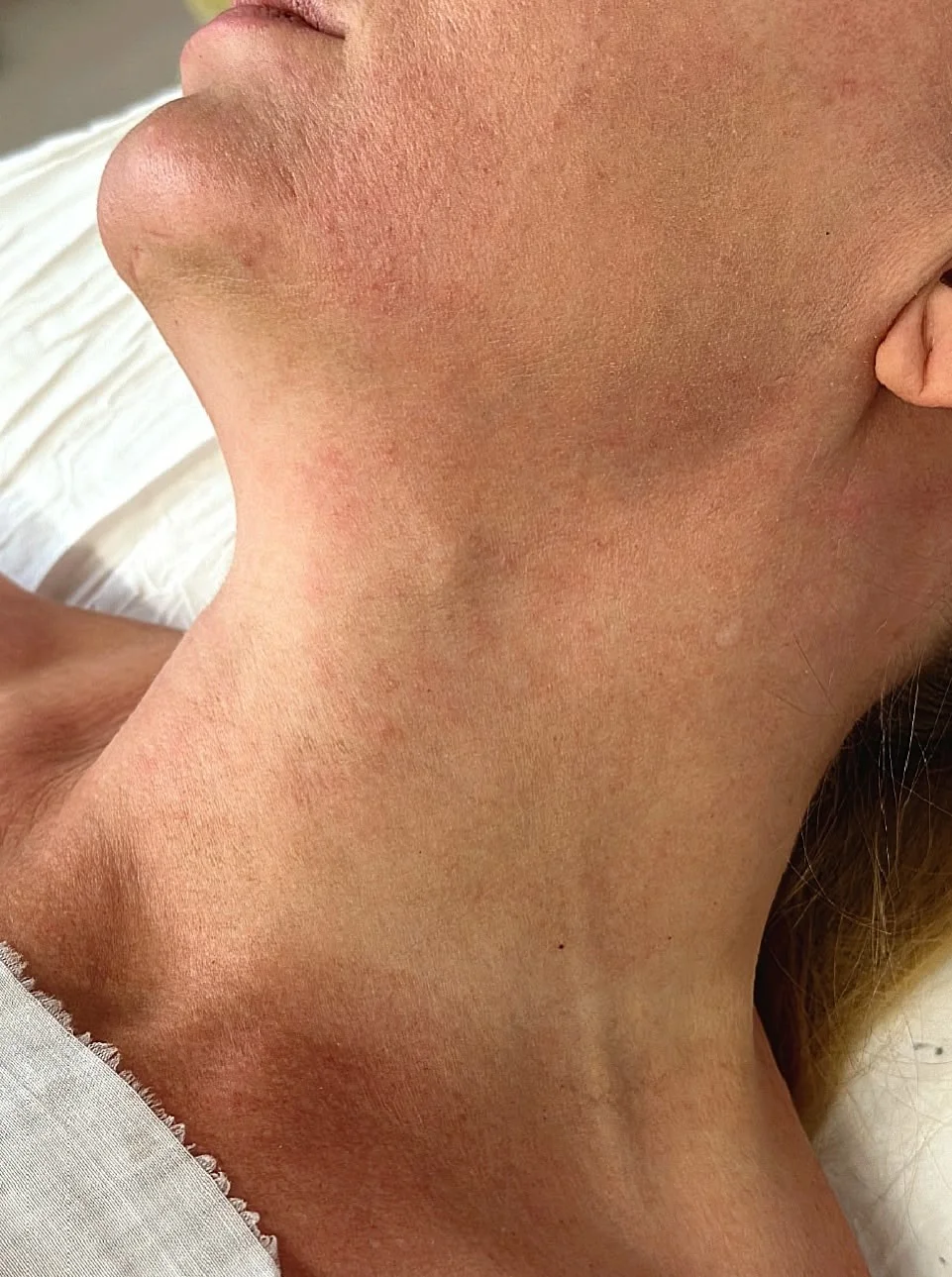 ИНТЕРЕСНЫЙ СЛУЧАЙ - ДИРОФИЛЯРИОЗА В ОТДЕЛЕНИИ ЧЕЛЮСТНО-ЛИЦЕВОЙ ХИРУРГИИ