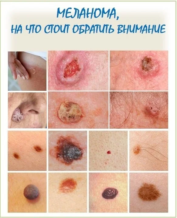 ПРОФИЛАКТИКА ОНКОЛОГИЧЕСКИХ ЗАБОЛЕВАНИЙ – РАК КОЖИ