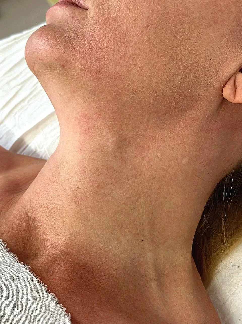 ИНТЕРЕСНЫЙ СЛУЧАЙ - ДИРОФИЛЯРИОЗА В ОТДЕЛЕНИИ ЧЕЛЮСТНО-ЛИЦЕВОЙ ХИРУРГИИ