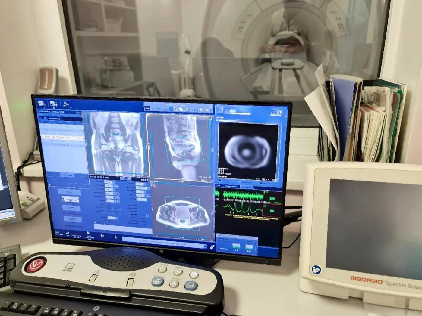  Проведено МРТ-исследование пациенту с имплантированным кардиостимулятором.