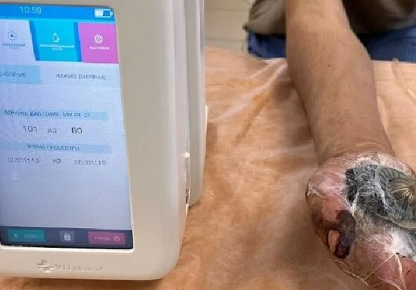 В хирургическом отделении № 4 Центральной городской клинической больницы активно используются передовые технологии для лечения ран