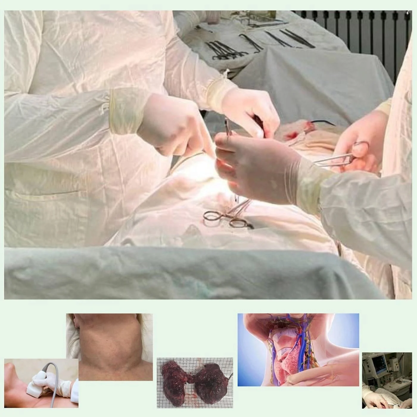 40 ЛЕТ ХОДИЛА С ГИГАНТСКИМ ЗОБОМ 40 ЛЕТ ХОДИЛА С ГИГАНТСКИМ ЗОБОМ