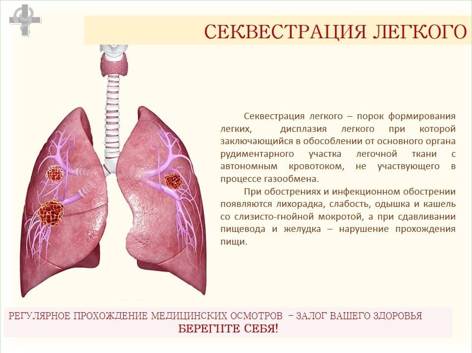 КЛИНИЧЕСКИЙ СЛУЧАЙ из практики отделения торакальной хирургии: секвестрация лёгких.