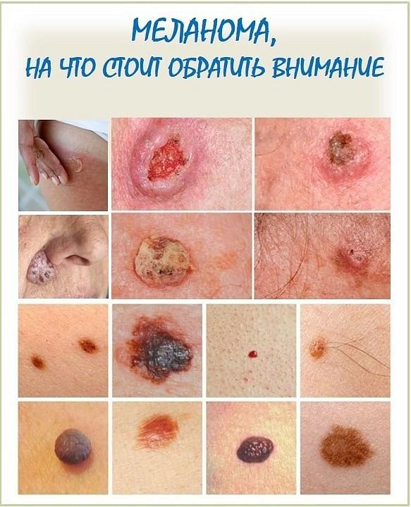 ПРОФИЛАКТИКА ОНКОЛОГИЧЕСКИХ ЗАБОЛЕВАНИЙ – РАК КОЖИ ПРОФИЛАКТИКА ОНКОЛОГИЧЕСКИХ ЗАБОЛЕВАНИЙ – РАК КОЖИ